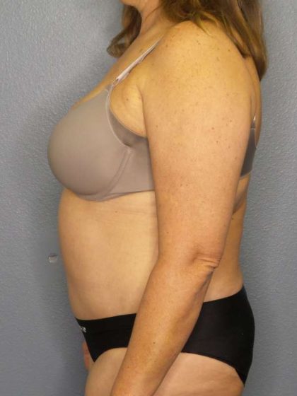 Abdominoplasty Before & After Patient #3692