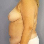Abdominoplasty Before & After Patient #3692