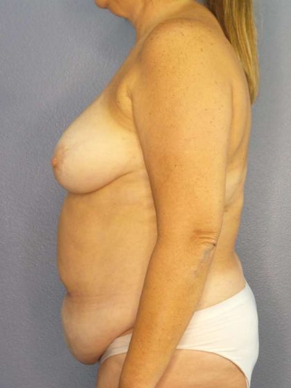 Abdominoplasty Before & After Patient #3692