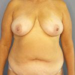 Abdominoplasty Before & After Patient #3692