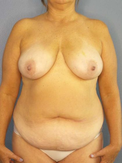 Abdominoplasty Before & After Patient #3692