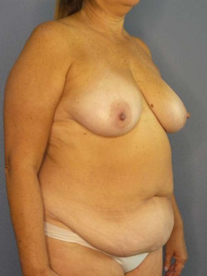 Abdominoplasty Before & After Patient #3692
