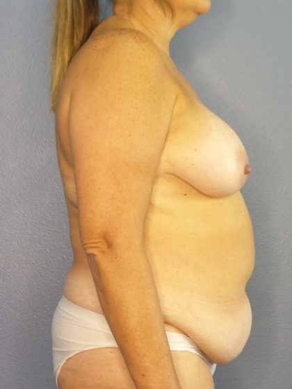 Abdominoplasty Before & After Patient #3692