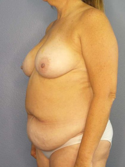 Abdominoplasty Before & After Patient #3692