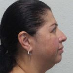 Periorbital Before & After Patient #8688
