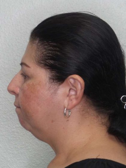 Periorbital Before & After Patient #8688