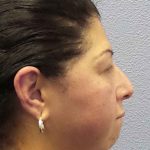 Periorbital Before & After Patient #8688