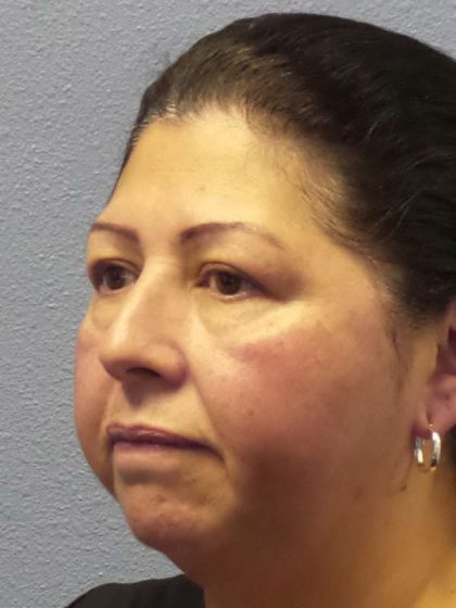 Periorbital Before & After Patient #8688