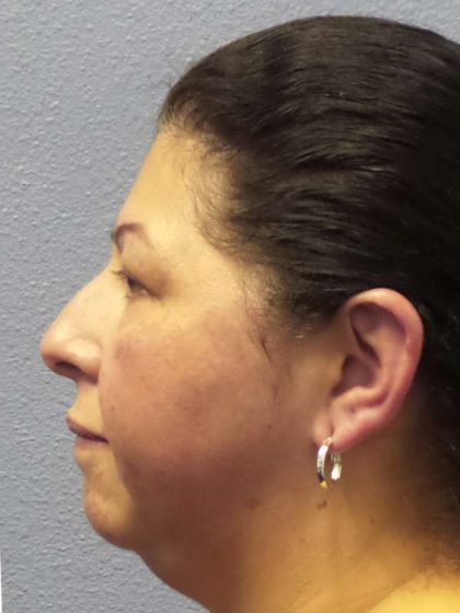 Periorbital Before & After Patient #8688
