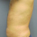Male Liposuction Before & After Patient #8177