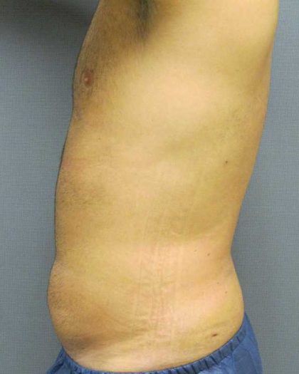 Male Liposuction Before & After Patient #8177