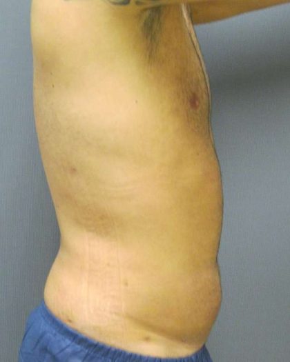 Male Liposuction Before & After Patient #8177