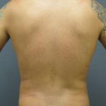Male Liposuction Before & After Patient #8177
