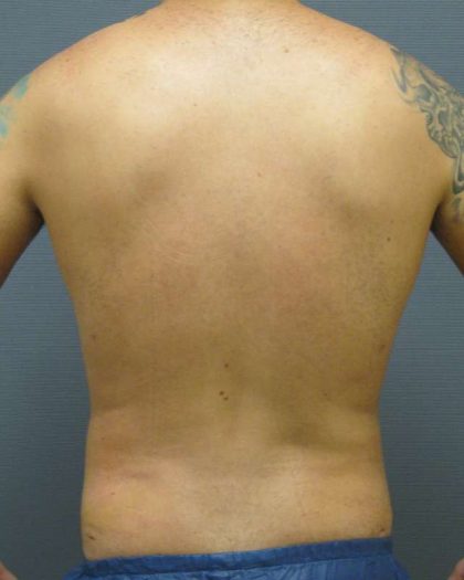 Male Liposuction Before & After Patient #8177