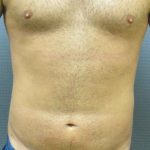 Male Liposuction Before & After Patient #8177