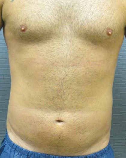 Male Liposuction Before & After Patient #8177