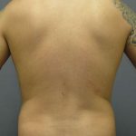 Male Liposuction Before & After Patient #8177