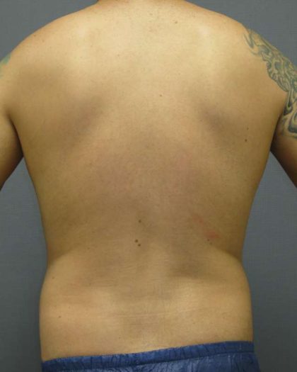 Male Liposuction Before & After Patient #8177