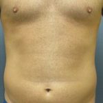 Male Liposuction Before & After Patient #8177
