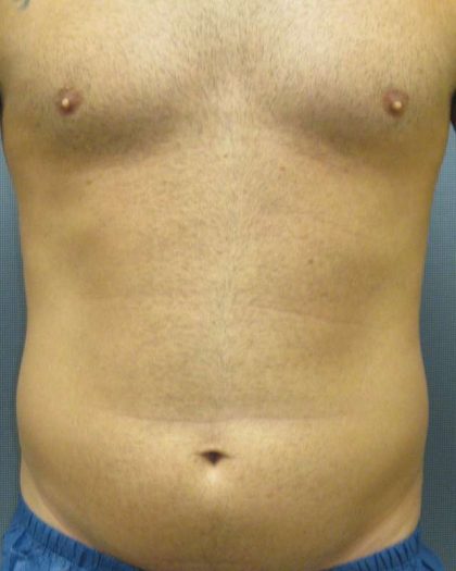 Male Liposuction Before & After Patient #8177