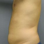 Male Liposuction Before & After Patient #8177