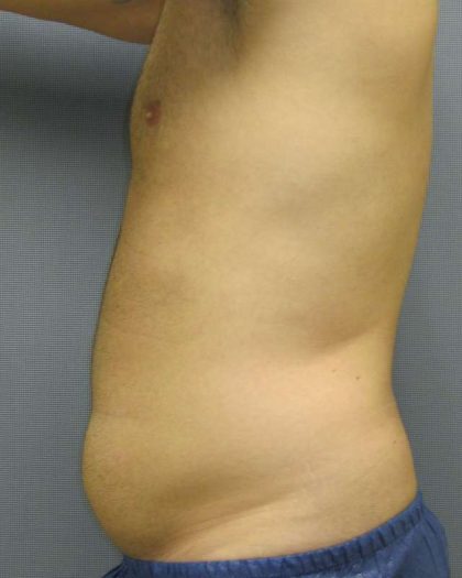 Male Liposuction Before & After Patient #8177