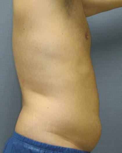 Male Liposuction Before & After Patient #8177