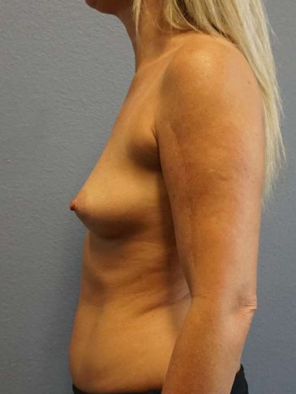 Breast Augmentation Before & After Patient #5133