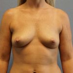 Breast Augmentation Before & After Patient #5133