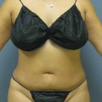 Liposuction Female Before & After Patient #11976