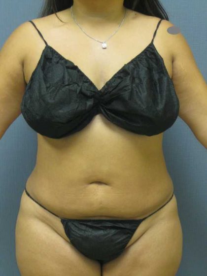 Liposuction Female Before & After Patient #11976