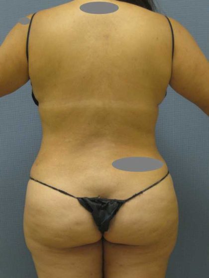 Liposuction Female Before & After Patient #11976