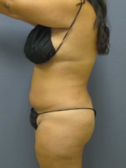 Liposuction Female Before & After Patient #11976