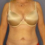 Abdominoplasty Before & After Patient #3823