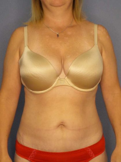 Abdominoplasty Before & After Patient #3823