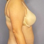 Abdominoplasty Before & After Patient #3823