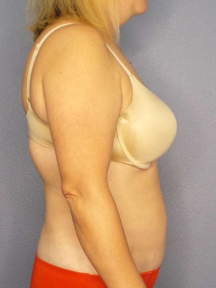 Abdominoplasty Before & After Patient #3823