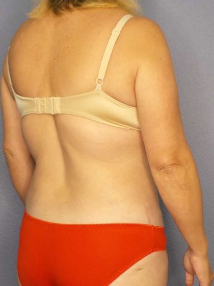 Abdominoplasty Before & After Patient #3823