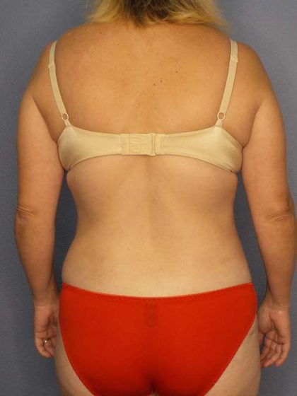 Abdominoplasty Before & After Patient #3823