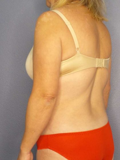 Abdominoplasty Before & After Patient #3823