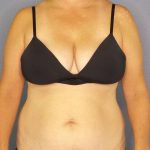 Abdominoplasty Before & After Patient #3823
