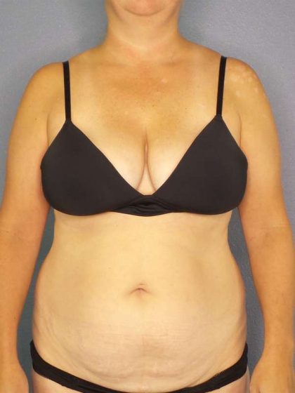 Abdominoplasty Before & After Patient #3823