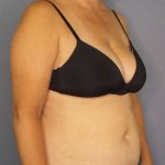 Abdominoplasty Before & After Patient #3823