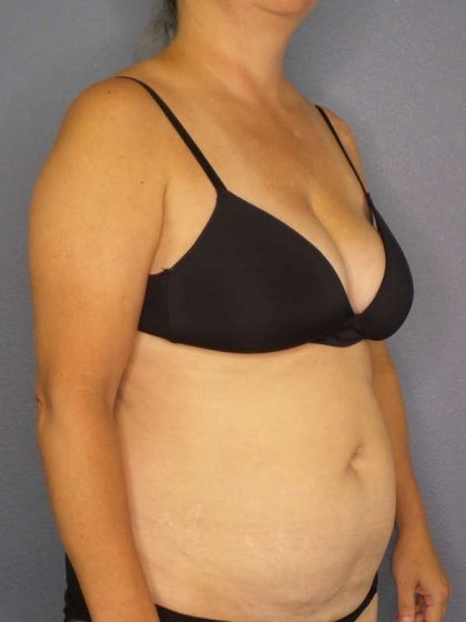 Abdominoplasty Before & After Patient #3823