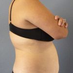 Abdominoplasty Before & After Patient #3823
