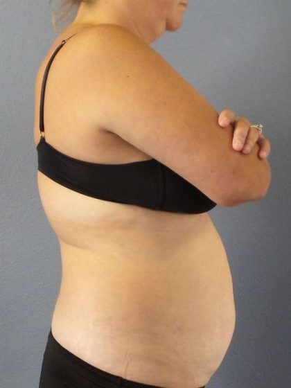 Abdominoplasty Before & After Patient #3823