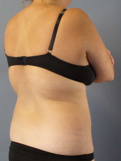 Abdominoplasty Before & After Patient #3823