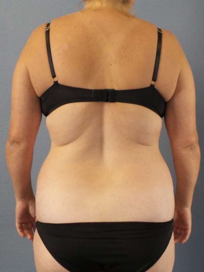 Abdominoplasty Before & After Patient #3823