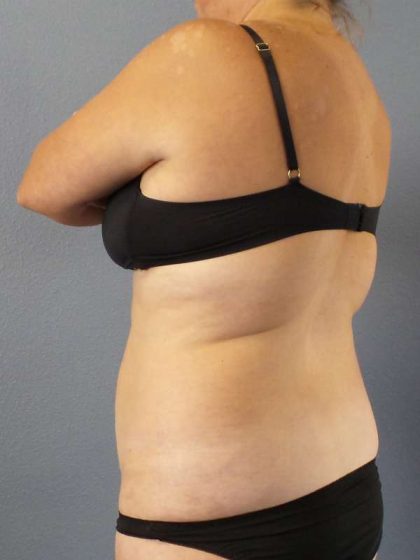 Abdominoplasty Before & After Patient #3823