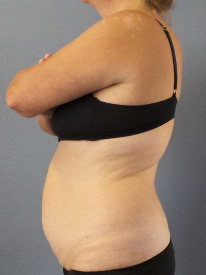 Abdominoplasty Before & After Patient #3823